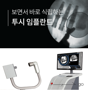 투시 임플란트