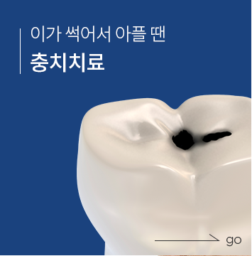 충치치료